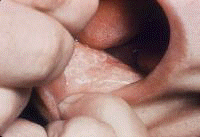 Lichen planus (oral lesions). Courtesy of Walter R